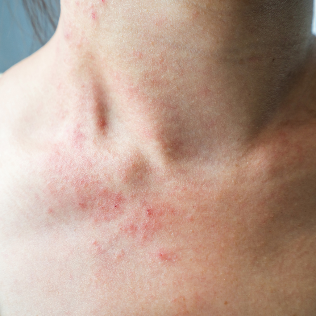 skin conditions eczema Holpura